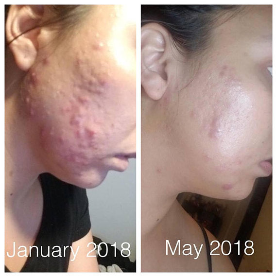 🤺😃Organic Super Acne Fighter|Acne Treatment