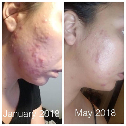 🤺😃Organic Super Acne Fighter|Acne Treatment