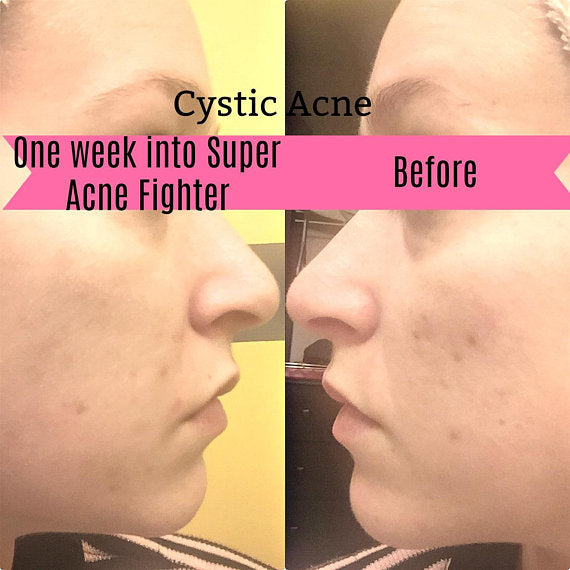 🤺😃Organic Super Acne Fighter|Acne Treatment